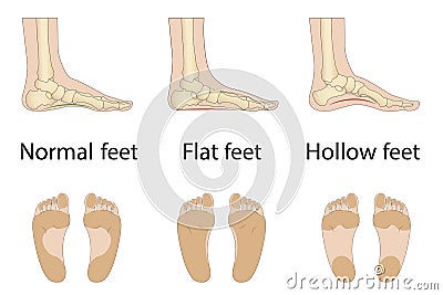 Foot deformity types, medical disease infographics. Stock Photo